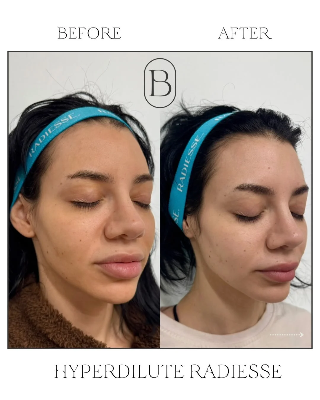 ✨ HYPERDILUTE RADIESSE&reg; &mdash; COLLAGEN, BUT MAKE IT NATURAL.

Not your traditional filler. Hyperdilute Radiesse&reg; works as a biostimulator, helping stimulate your own collagen production to gradually improve skin quality, firmness and overal