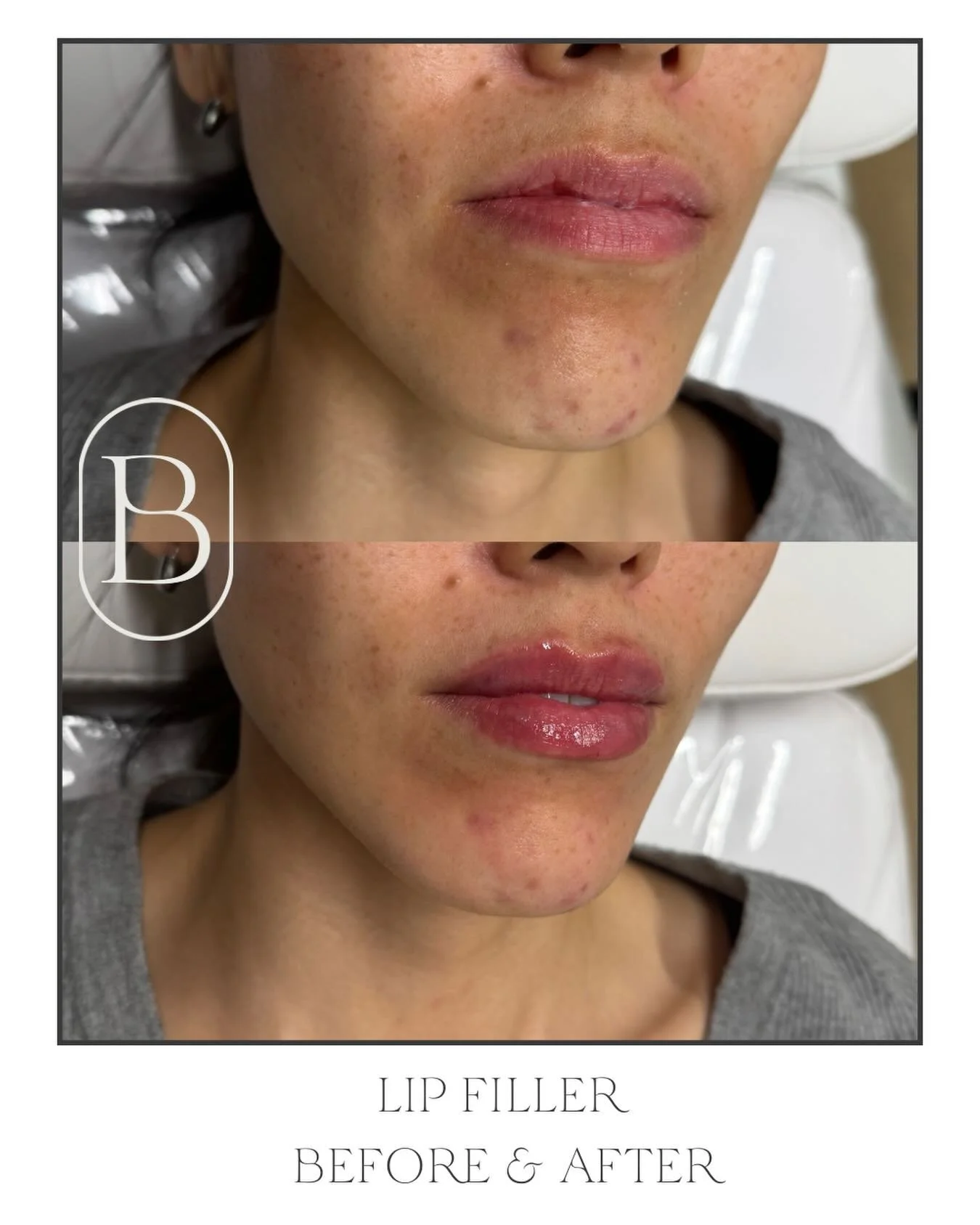 ✨ Natural Lip Enhancement ✨

Sometimes, less is more 💋

Just &frac12; syringe of lip filler was used to add subtle volume, enhance the shape, and create a soft, hydrated look while keeping her lips beautifully natural.

Perfect for first-time lip fi