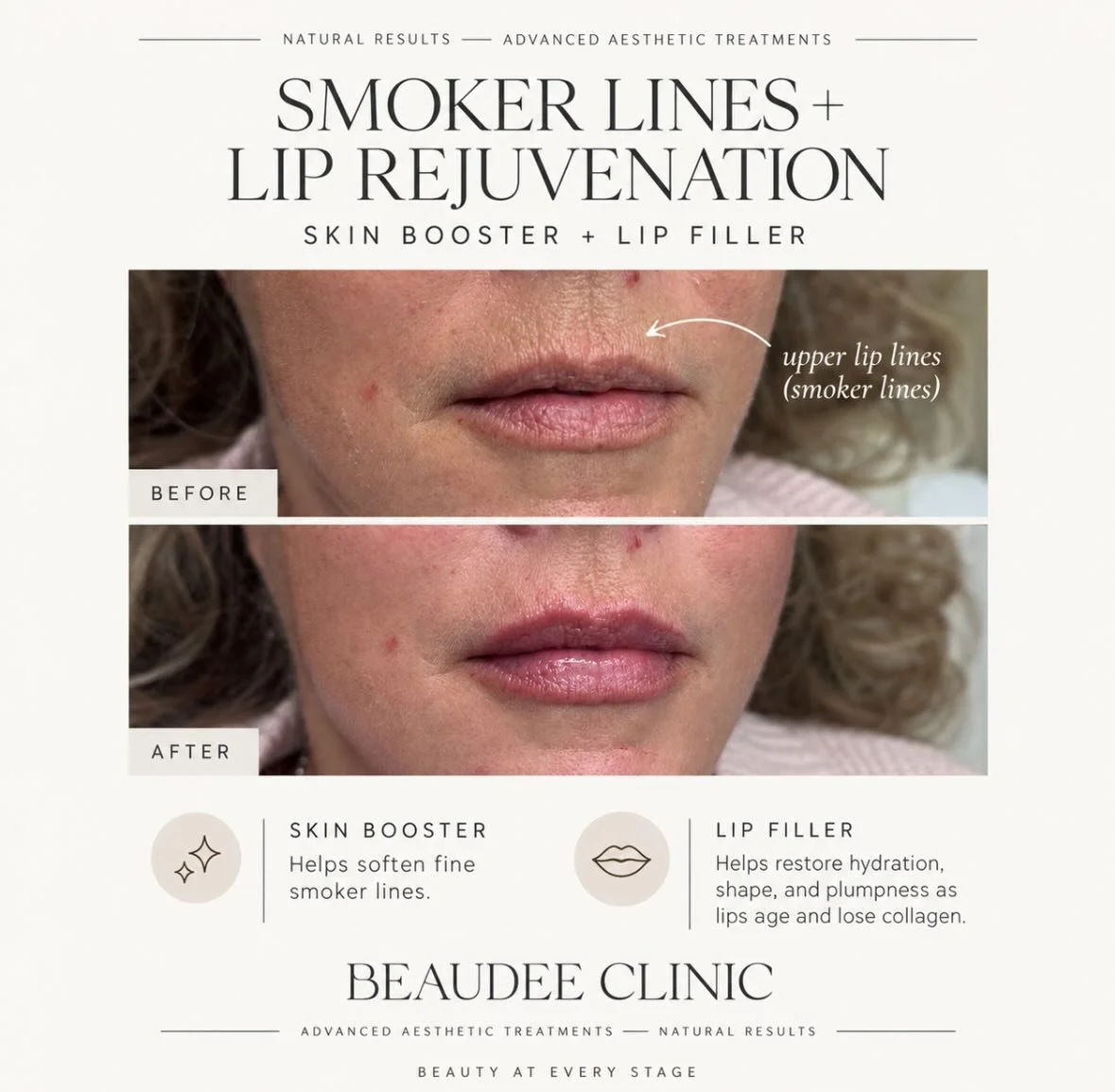 Aging lips don&rsquo;t always need &ldquo;more filler&rdquo; &mdash; sometimes they need restoration. ✨

For this client, we treated both the lips and the fine lines around the mouth to create a softer, refreshed result while still keeping everything
