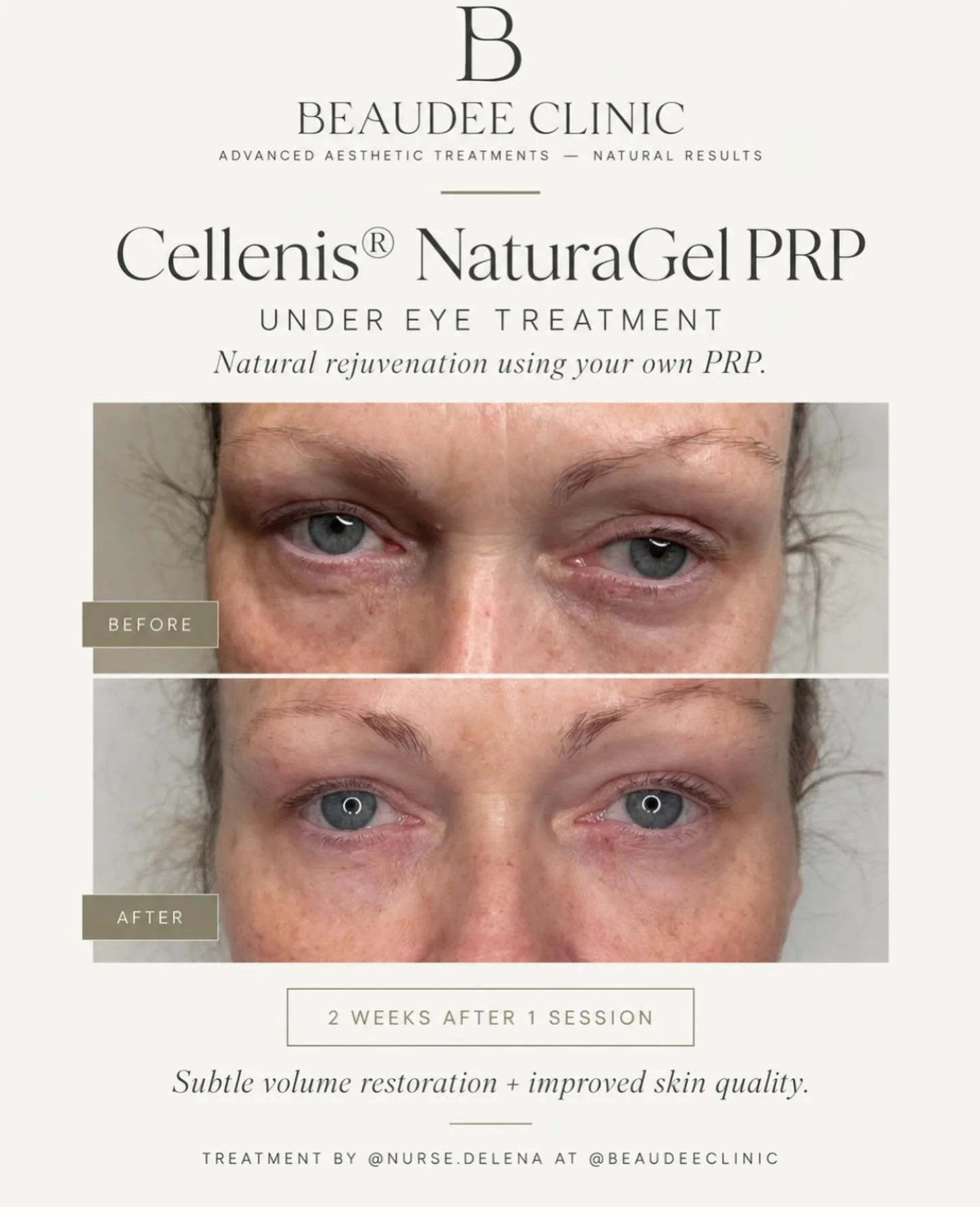 Cellenis&reg; NaturaGel PRP ✨

A natural approach to rejuvenation using your own PRP.

NaturaGel can help improve the appearance of under-eye hollowness, skin quality and overall rejuvenation &mdash; but it&rsquo;s important to understand that Natura
