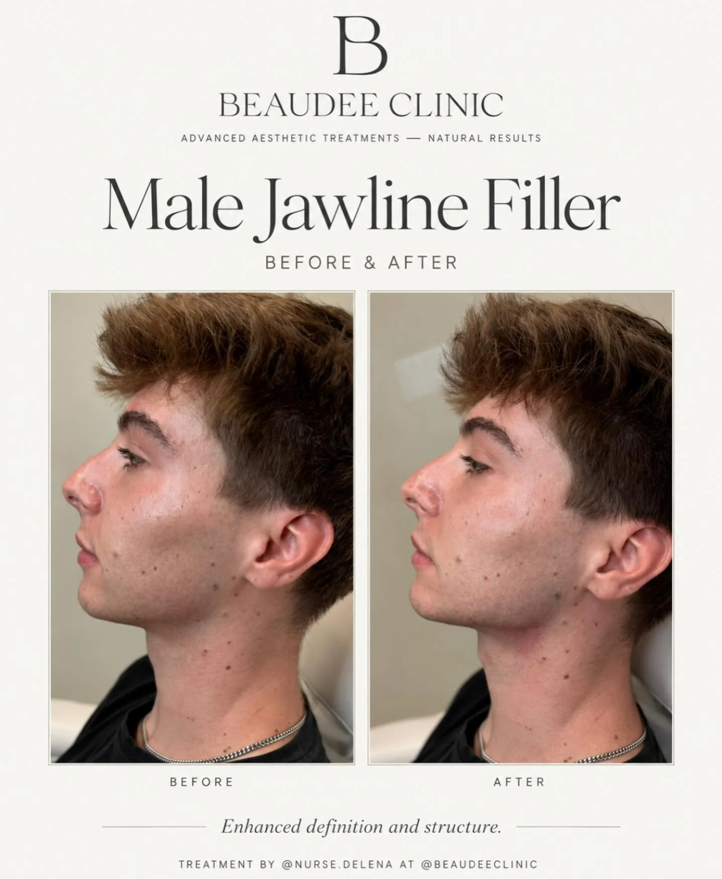 Male Jawline Filler ✨

A subtle enhancement can make a big difference in overall facial balance. For this treatment, we focused on creating a sharper, more defined jawline while keeping the result natural and masculine.

Jawline filler can help:
&bul
