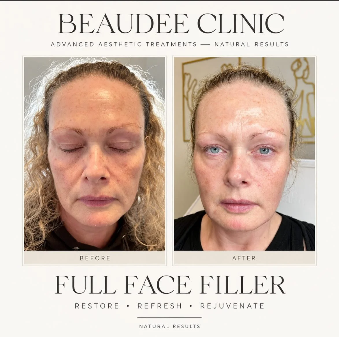 FULL FACE REJUVENATION | 4 SYRINGES OF DERMAL FILLER 🤍

It&rsquo;s not about changing your face. It&rsquo;s about restoring what time has taken away.

For this beautiful client, we used approximately 4 syringes of dermal filler to strategically rest