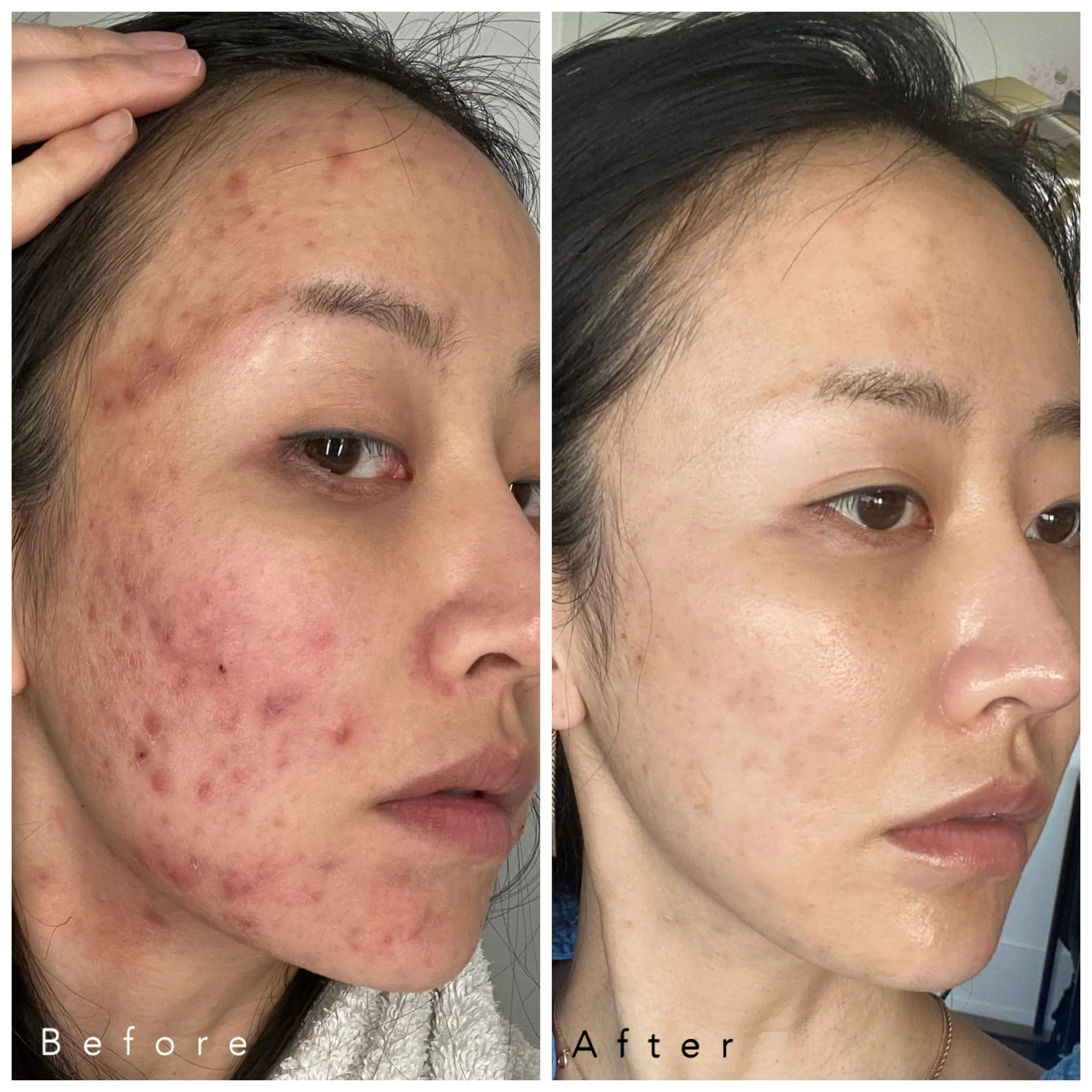 Stress, Gut Health &amp; Acne: Why True Skin Healing Begins Within