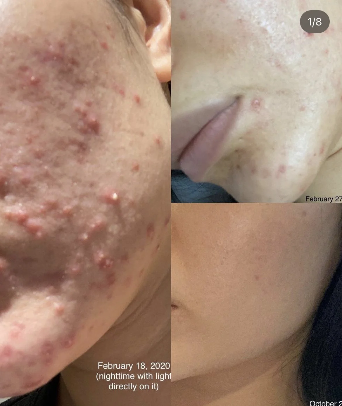 Professional Acne Treatments That Actually Work