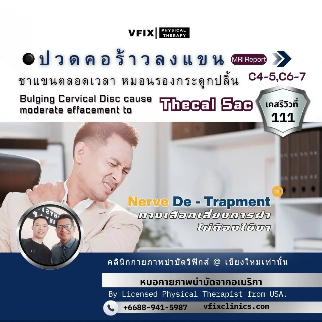 กรณีศึกษา: ทางเลือกเลี่ยงการผ่าตัดกระดูกคอทับเส้นประสาท ด้วย Vfix Technique &amp; ProtocolNerve De-Trapment Technique