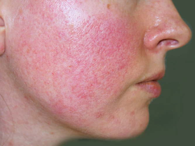 Rosacea: Everything You Need to Know About It