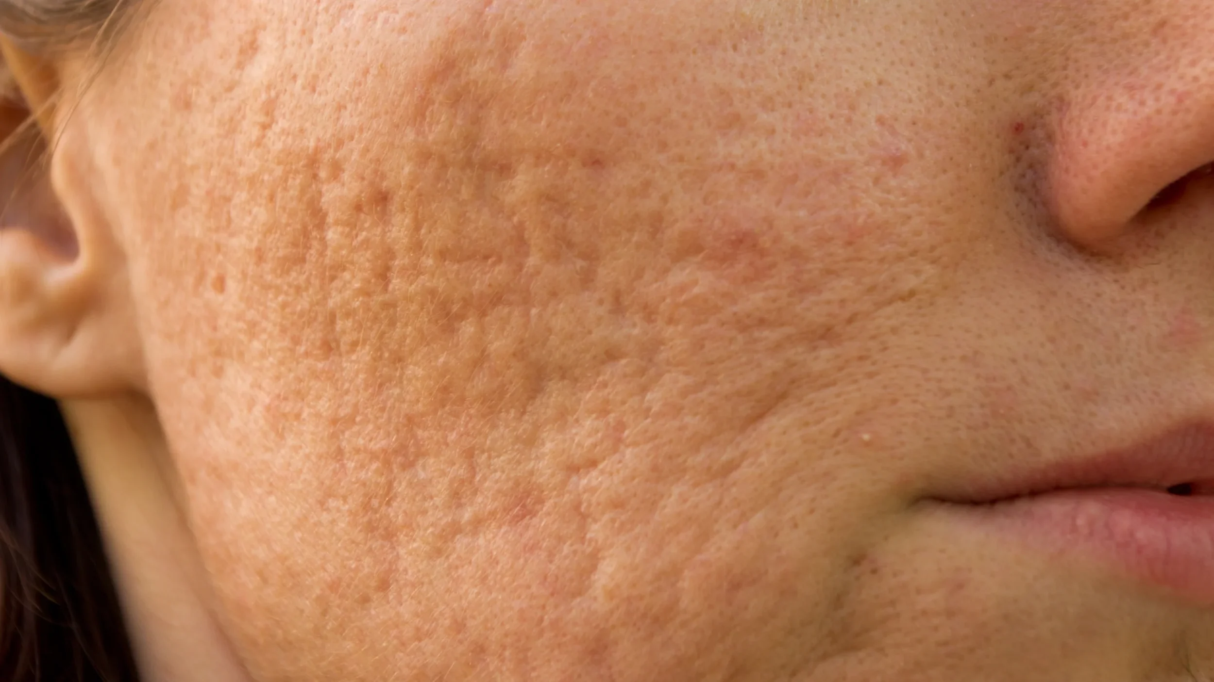 Post-acne scarring. How does it appear, why, and how to get rid of it?