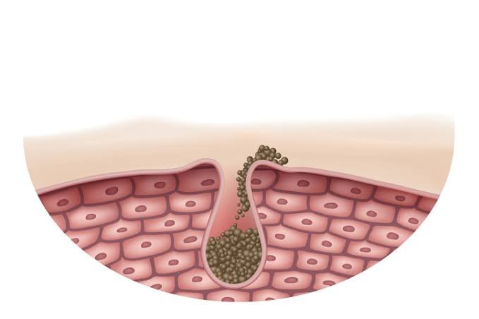 Clear Skin: Tackling Blackheads and Whiteheads