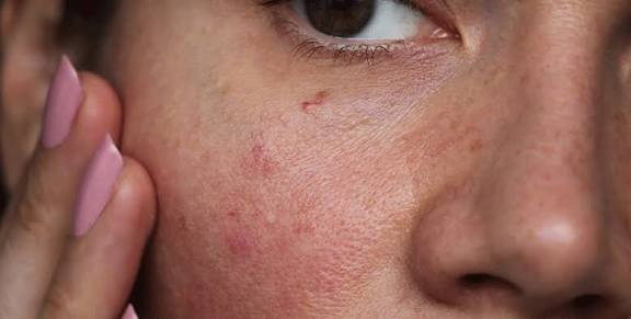 Skin types and appropriate skin care. Part 2: Dry and sensitive skin.