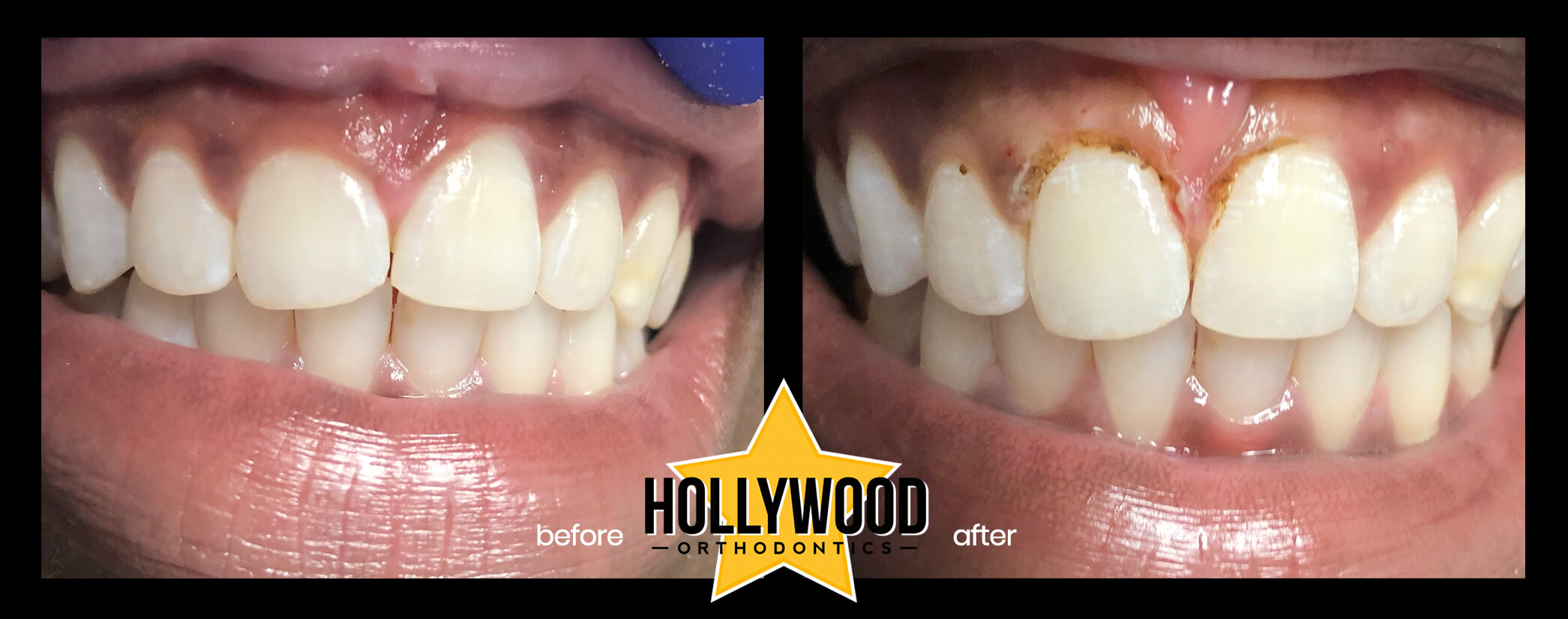 Close-up of a person's teeth before and after orthodontic treatment, showing improved alignment and whitening, with the Hollywood Orthodontics logo.