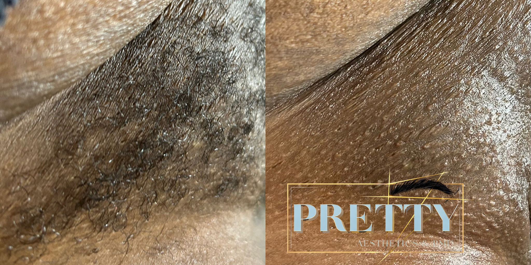 Brazilian Wax