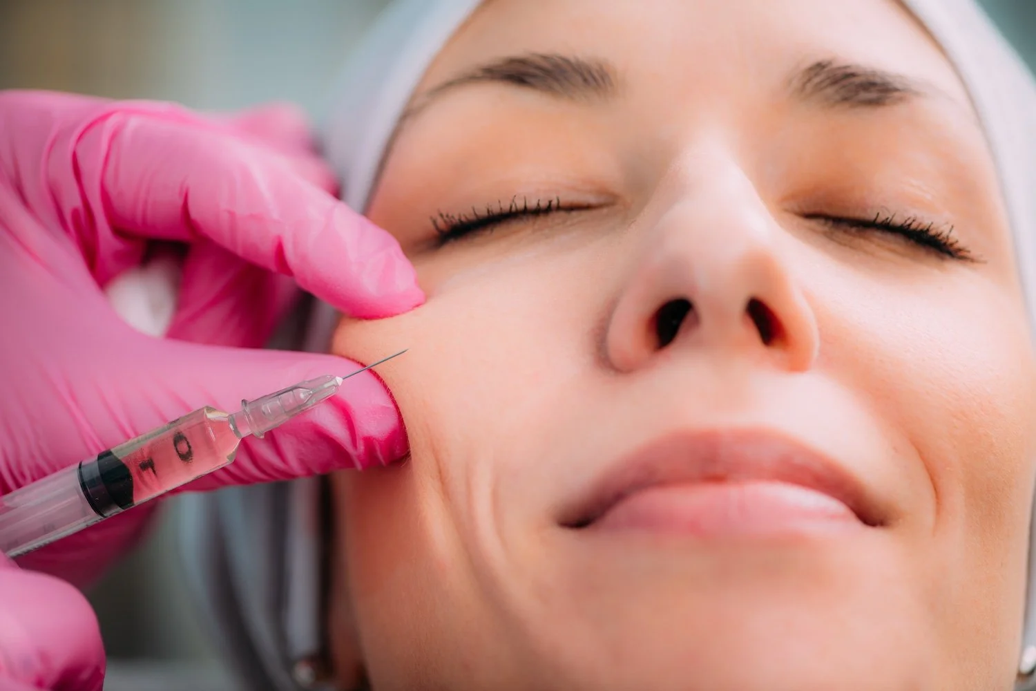 Dermal fillers for the face done in livermore ca.
