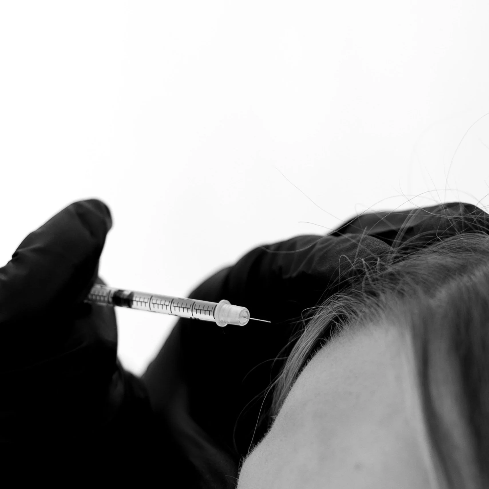 A person administering an injection into a person's scalp with a syringe, wearing black gloves.