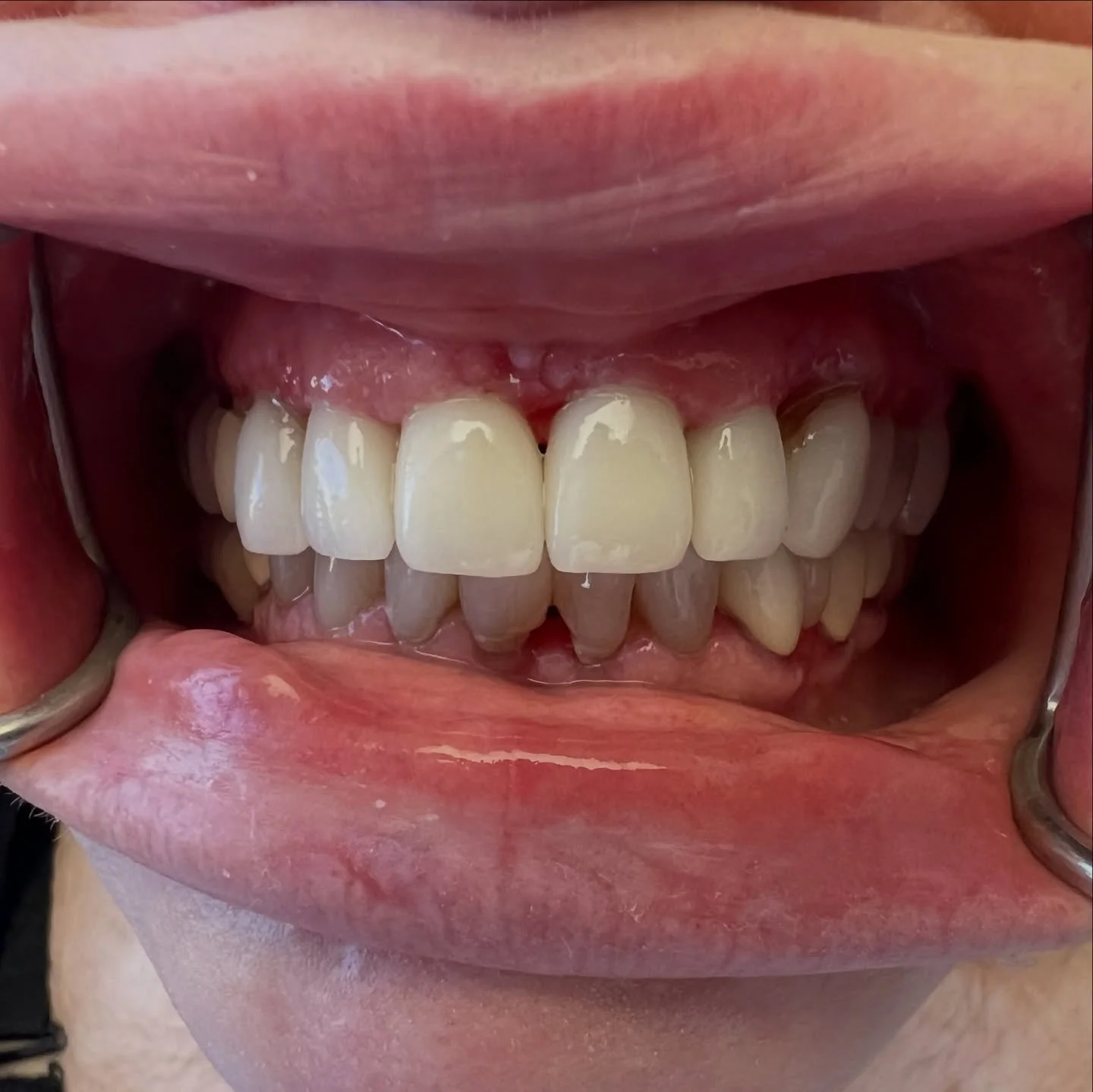 Patient lost #8 tooth and had implant placed, patient unhappy with shape and color of existing crowns. Removed existing #7, #9, and #10 crowns and fabricated new crowns with new implant crown #8 to replace tooth and offer optimal esthetics. Patient w