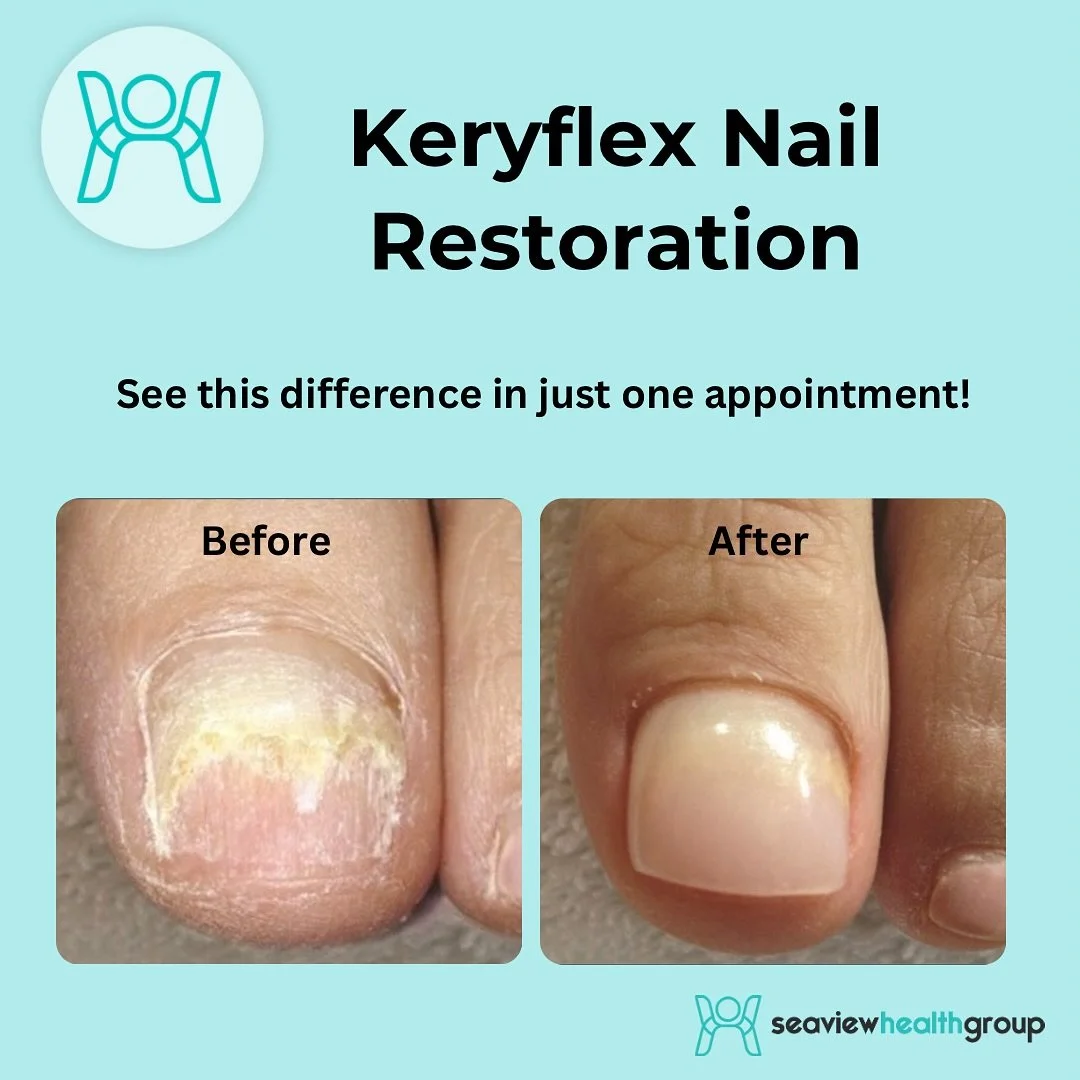 Struggling with brittle, discolored, or damaged toenails? Our Keryflex Nail Restoration treatment restores the appearance of natural, healthy nails instantly.

- Non-invasive
- Immediate results
- Beautiful, natural finish

See the incredible before 