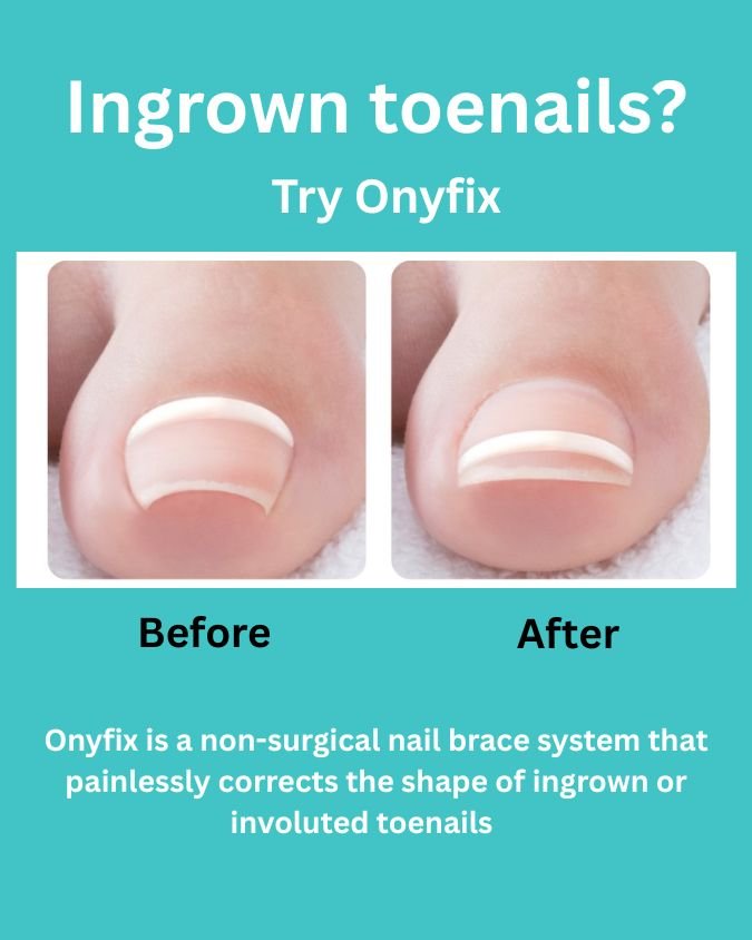 Say goodbye to painful ingrown or involuted nails! 💅

The Onyfix nail bracing system gently corrects the nail&rsquo;s natural growth&mdash;without surgery, without pain, and without downtime.

Perfect for clients looking for a safe, effective, and c