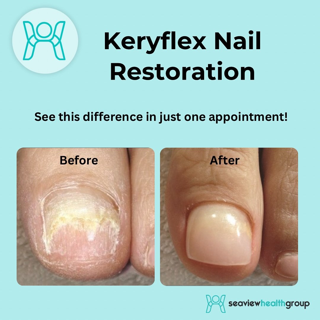 Struggling with brittle, discolored, or damaged toenails? Our Keryflex Nail Restoration treatment restores the appearance of natural, healthy nails instantly.

- Non-invasive
- Immediate results
- Beautiful, natural finish

See the incredible before 