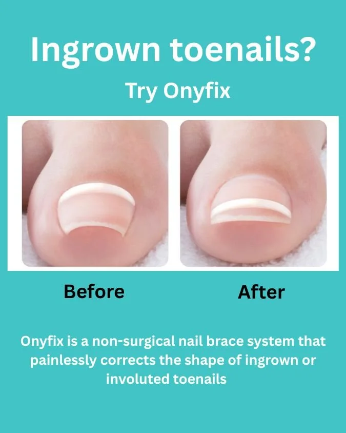 Say goodbye to painful ingrown or involuted nails! 💅

The Onyfix nail bracing system gently corrects the nail&rsquo;s natural growth&mdash;without surgery, without pain, and without downtime.

Perfect for clients looking for a safe, effective, and c