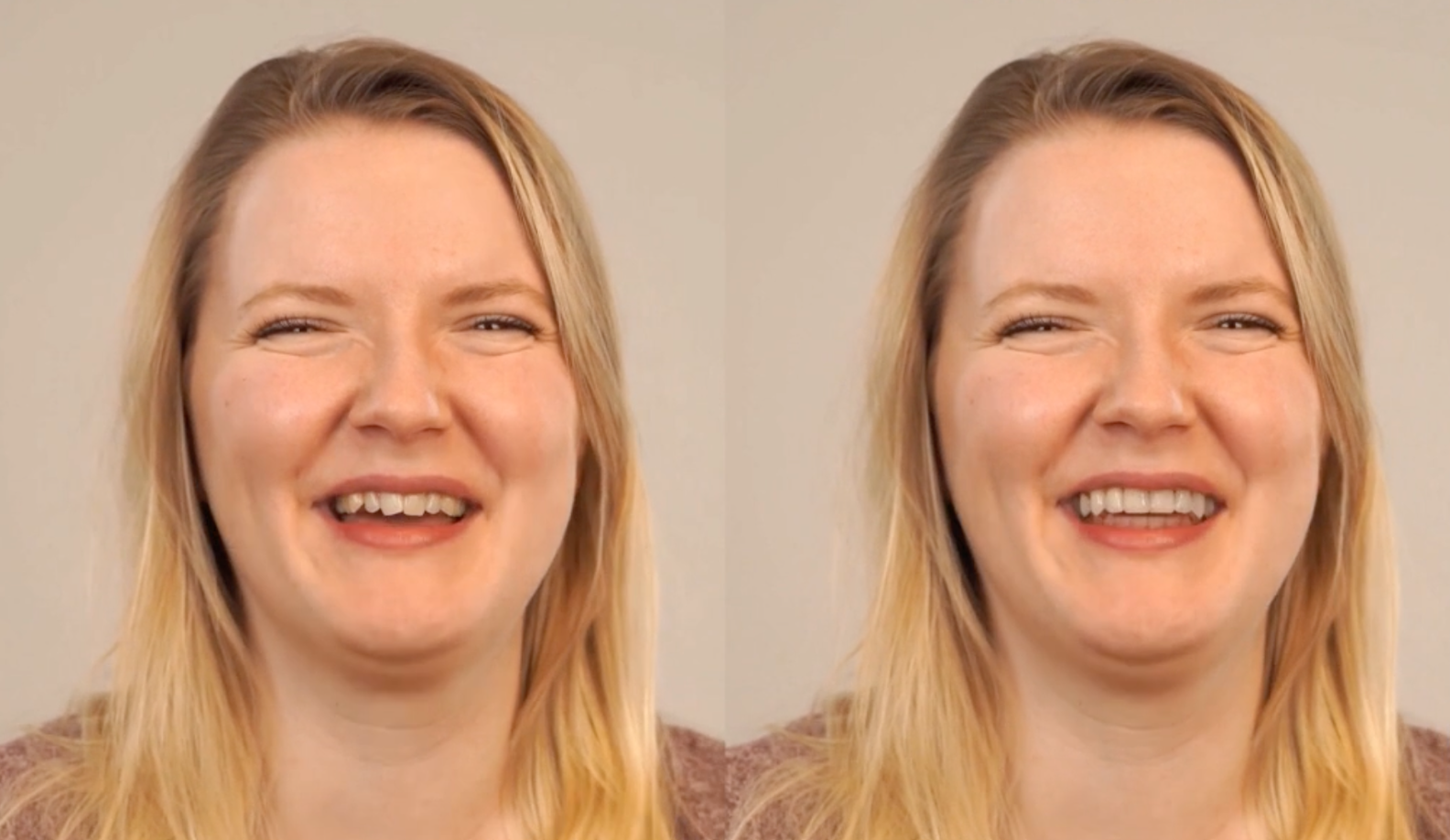 Bekijk je toekomstige glimlach met Invisalign Smile Video