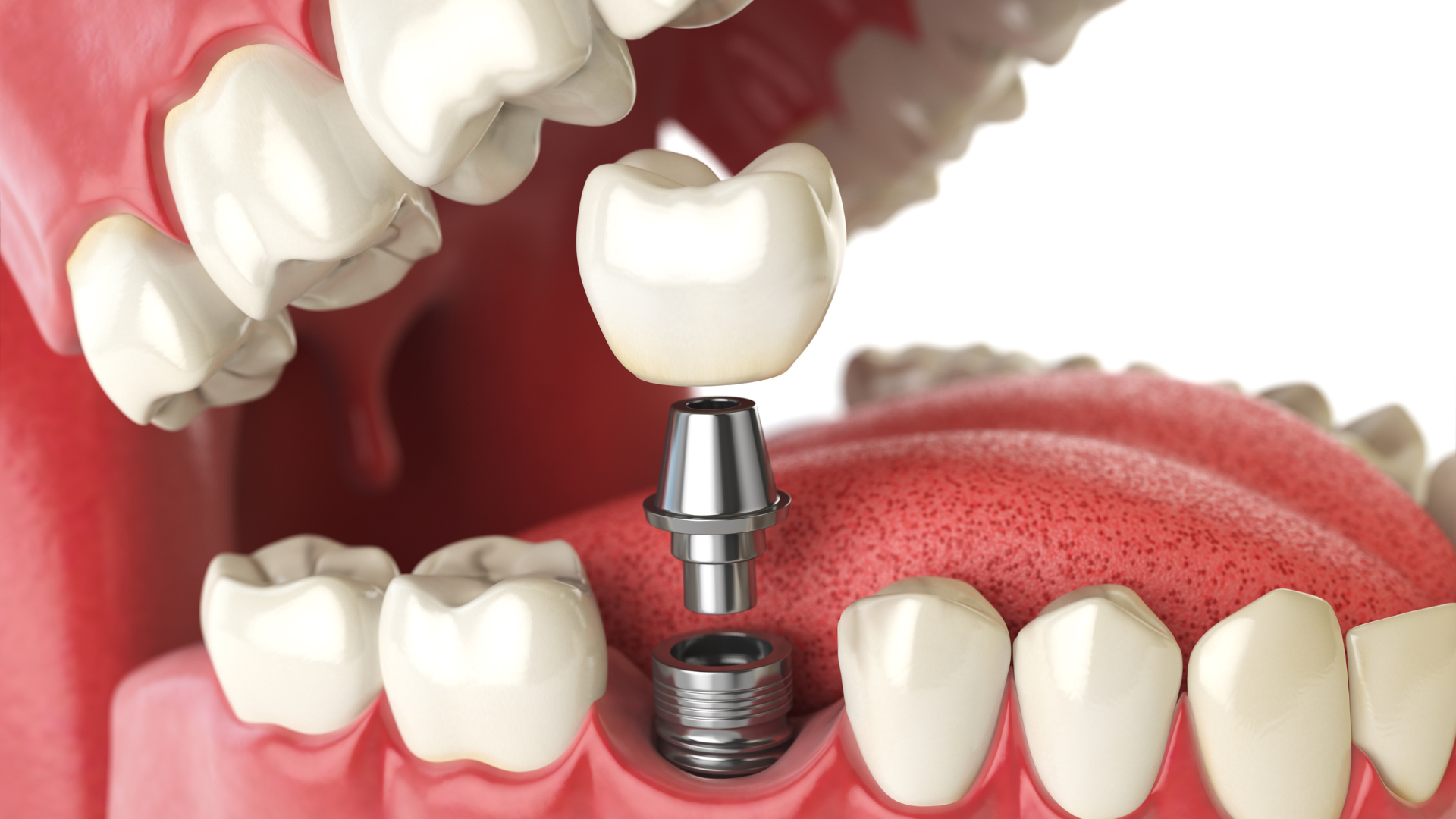 Single Tooth vs. Full Arch: Understanding Your Implant Options