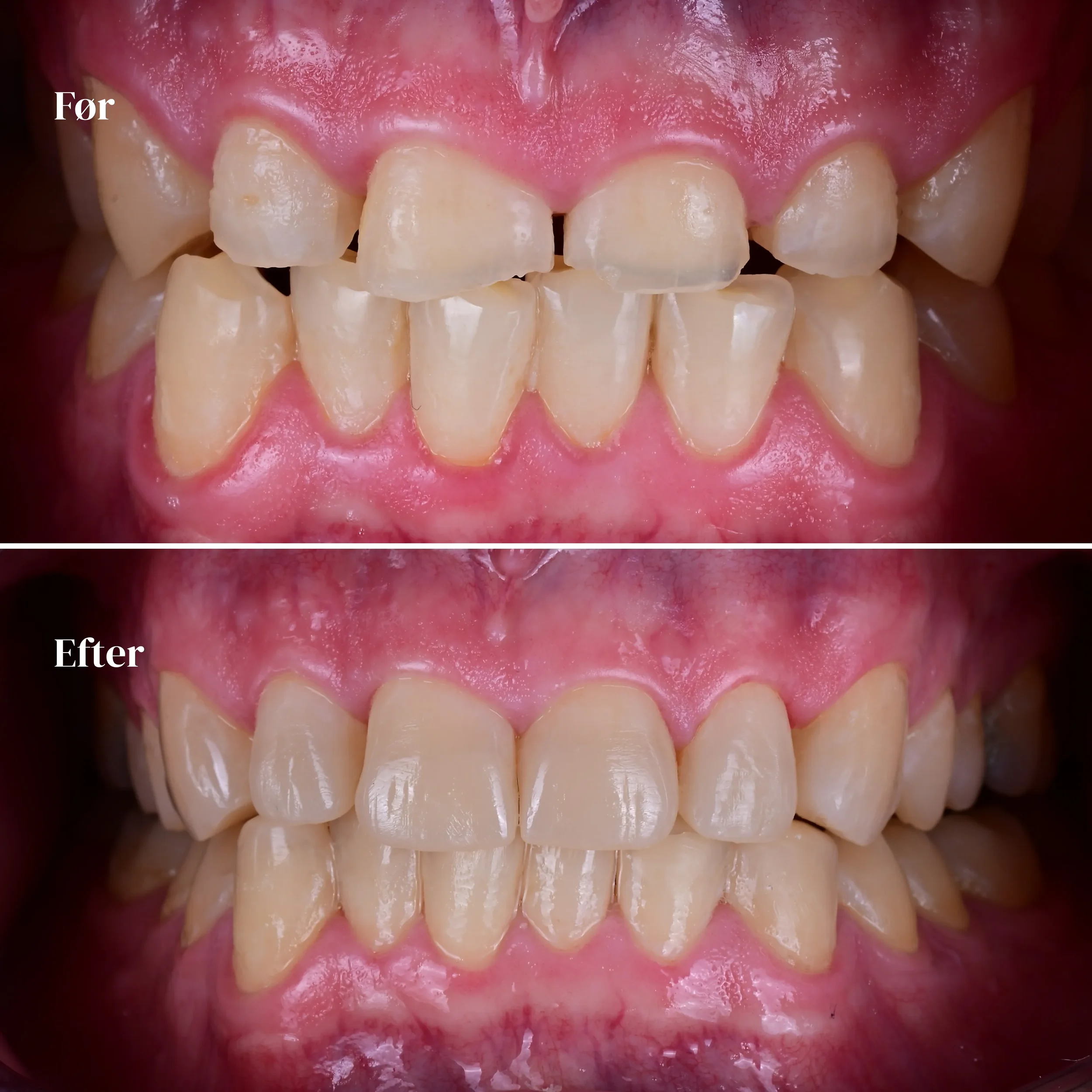 Før og efter billeder af tænder, hvor tænderne er blevet rettet og whitening-behandlet.