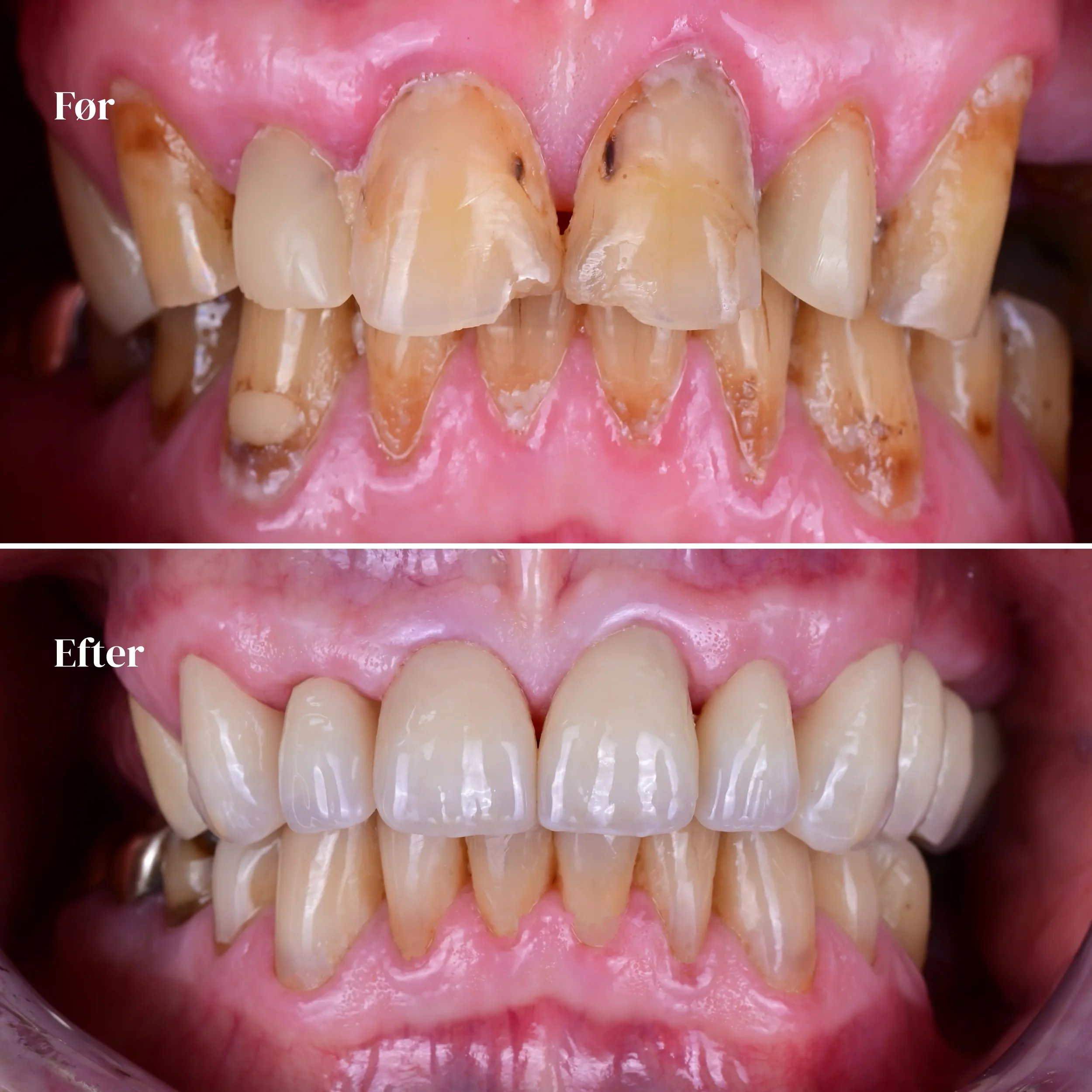 Før: Tænder med alvorlig misfarvning, erosionsskader og skæve positioner. Efter: Renere, mere symmetriske og hvide tænder, efter tandbehandling.