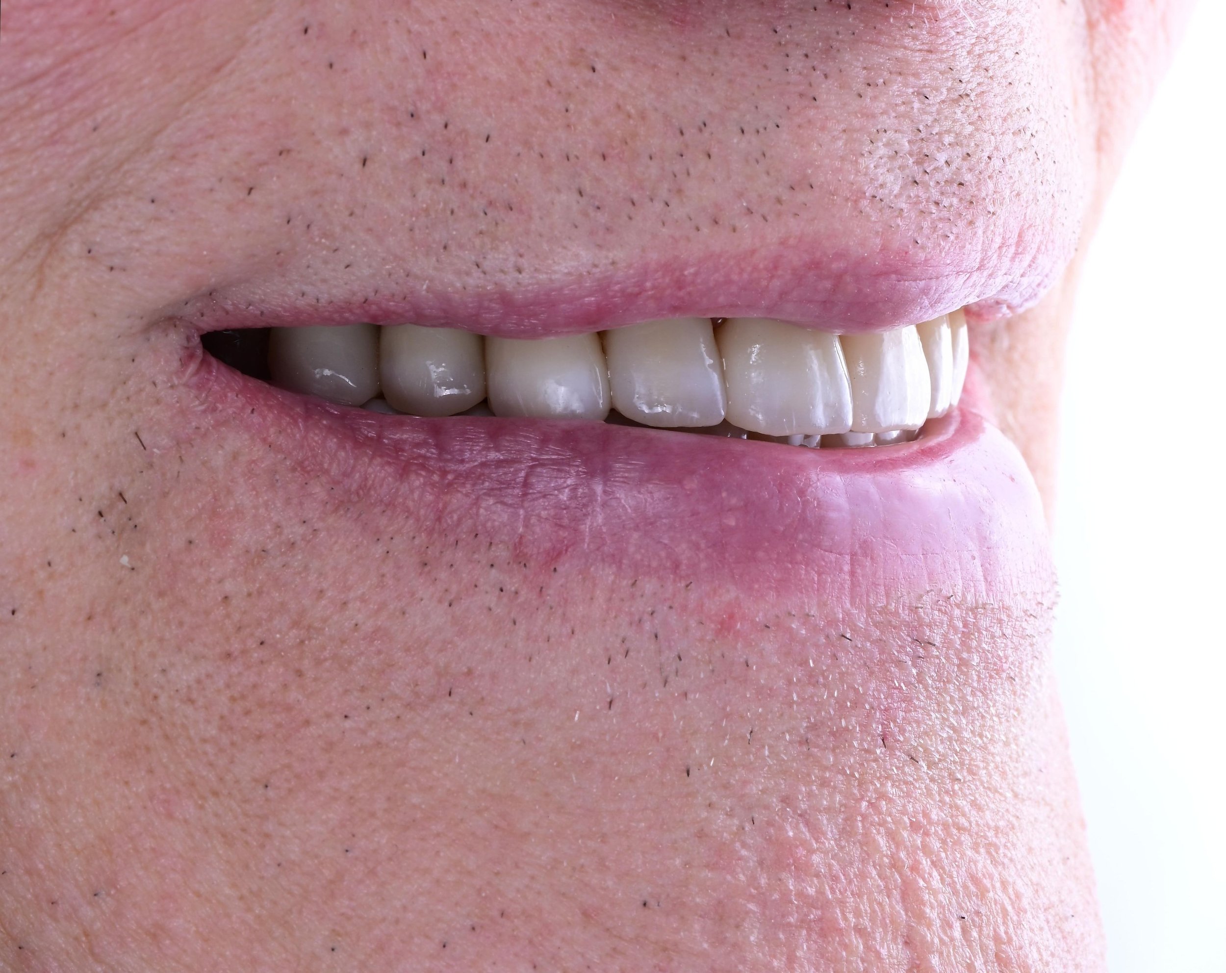 Et smil, der passer til ansigtet