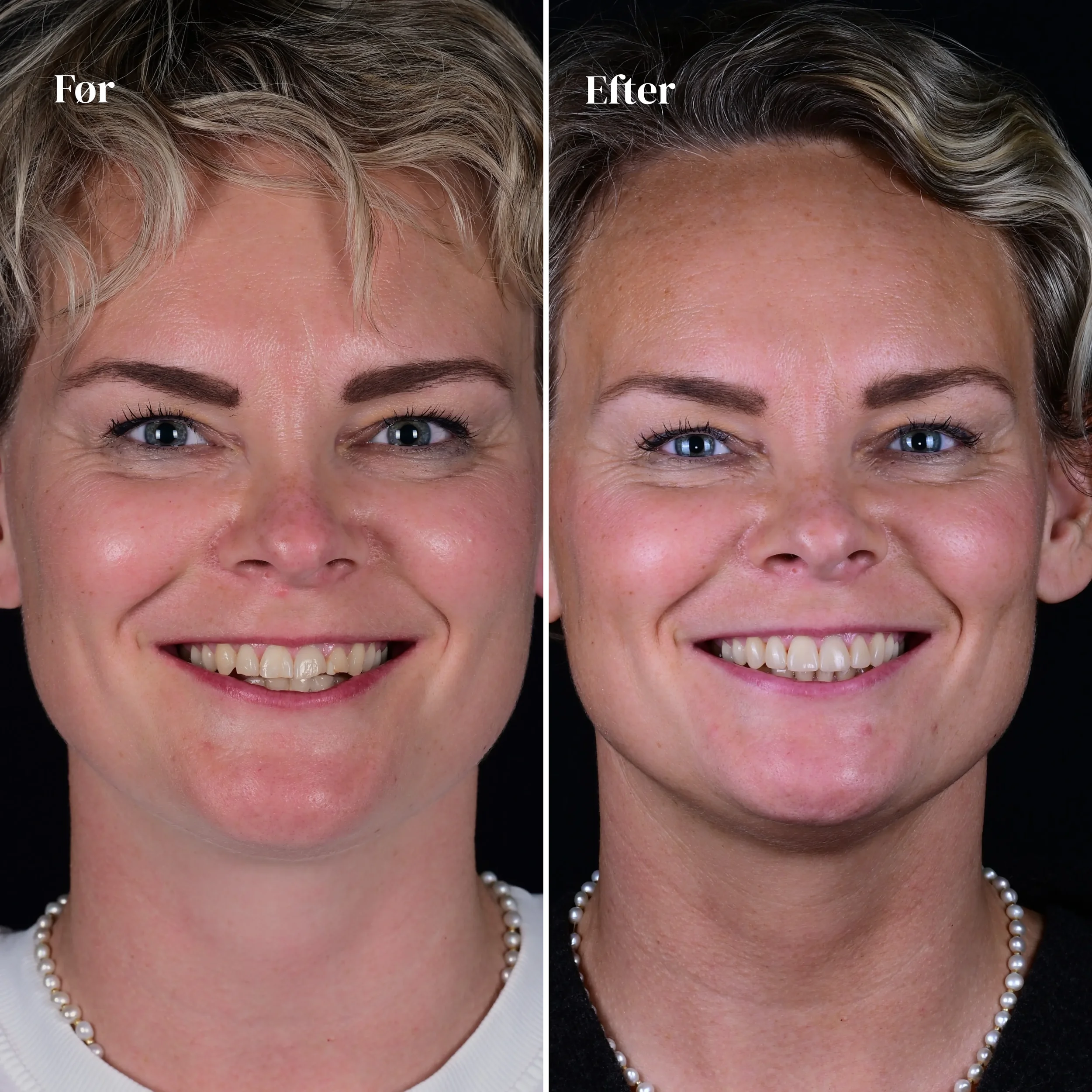 Før og efter bidhævning