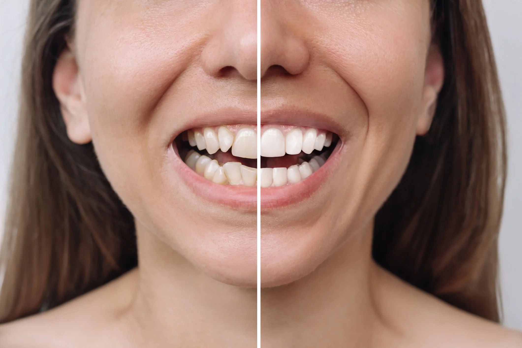En fotoshoppet billede af en kvindes glade smil, der viser hende både med og uden tænder.