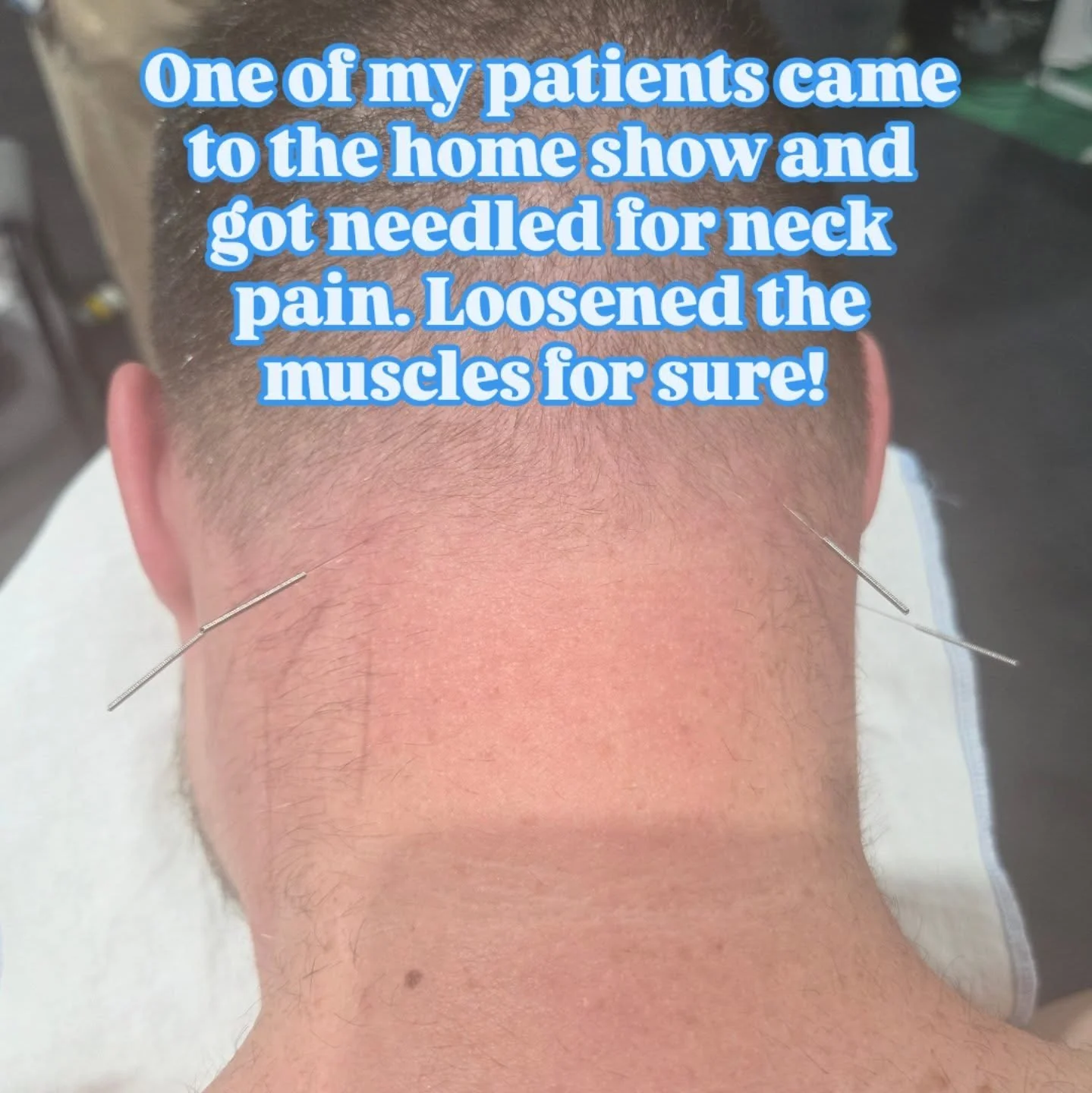 #acupuncturemapleridge #painrelief #naturalhealing #acupunctureworks #dryneedling