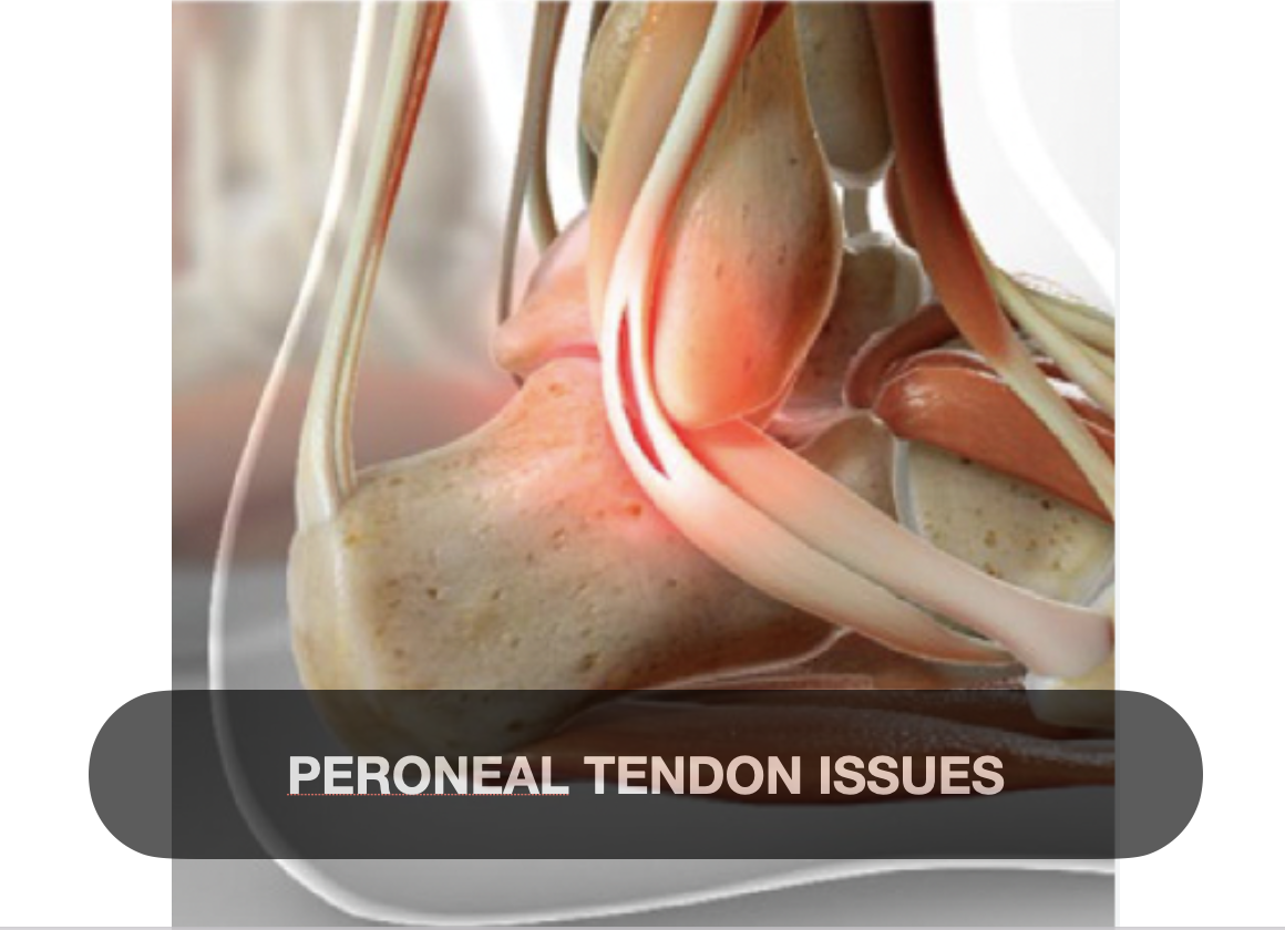 Close-up of a dissection of a human shoulder showing tendons and muscles, with focus on peroneal tendon issues.