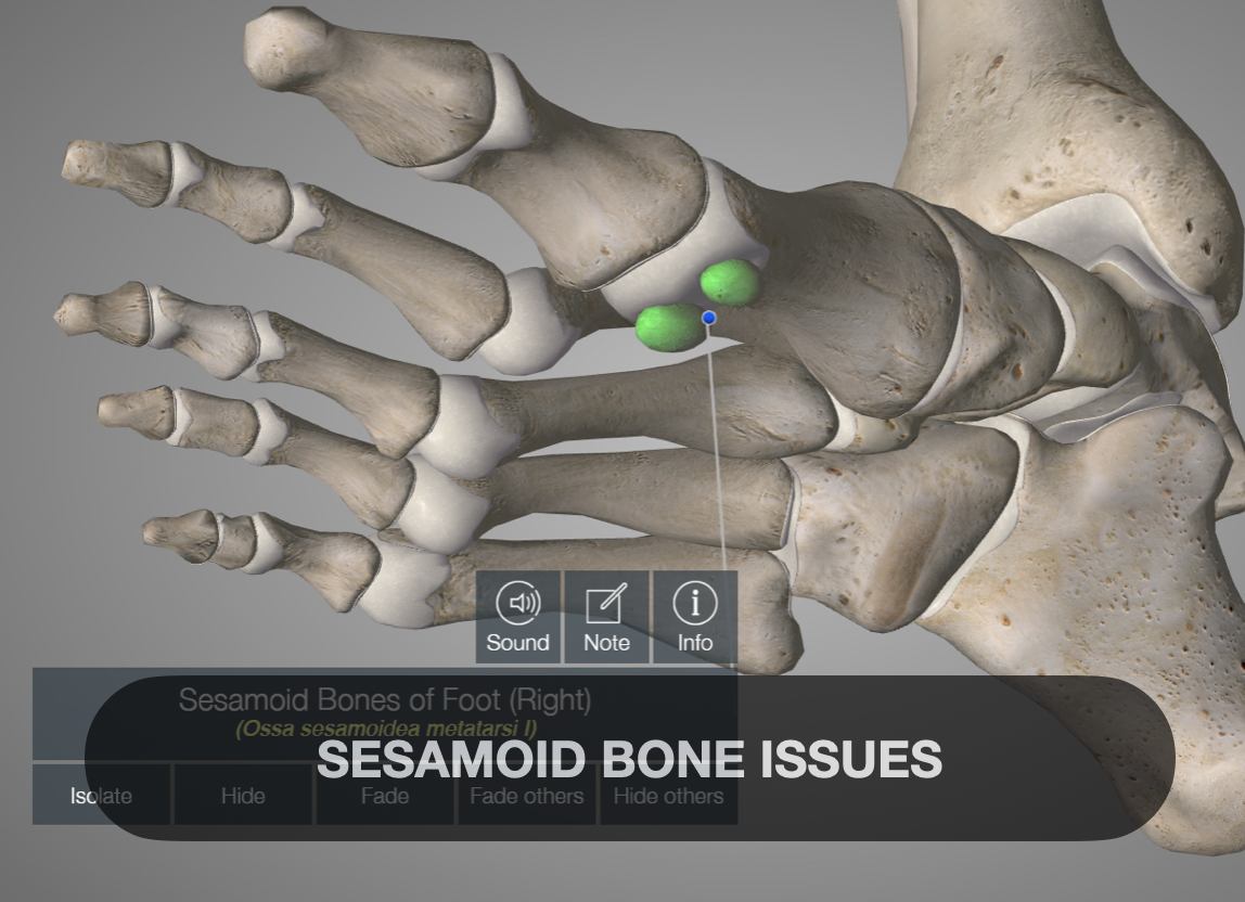 3D model of human foot bones highlighting sesamoid bones, with text overlay reading "Sesamoid Bone Issues" and options for annotations below.