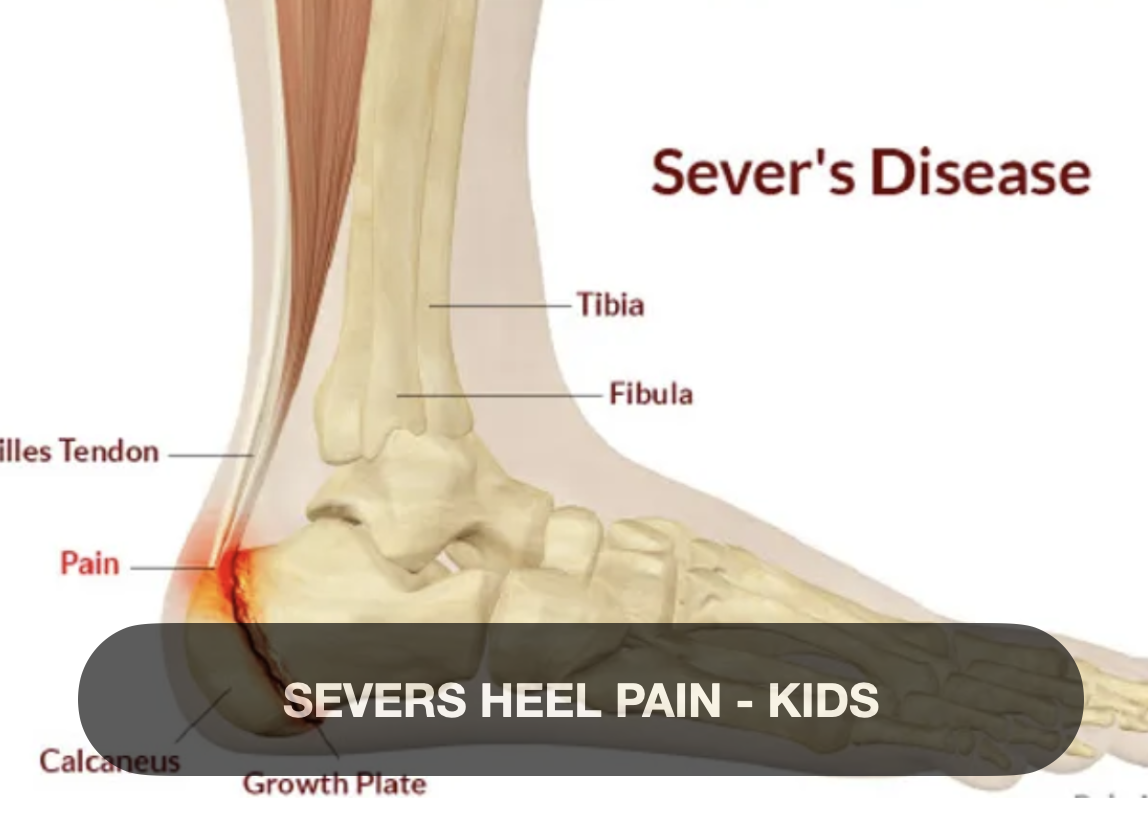 Diagram of a foot showing heel pain caused by Sever's disease, with labels for tibia, fibula, Achilles tendon, calcaneus, growth plate, and pain area.
