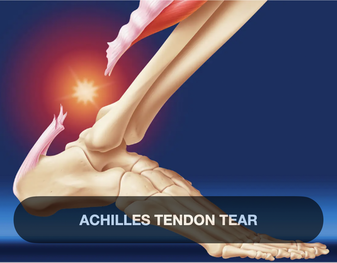 A medical illustration showing a tear in the Achilles tendon of the ankle, with bones, muscles, and tendons visible, and a bright sun in the background. The text reads 'Achilles Tendon Tear'.
