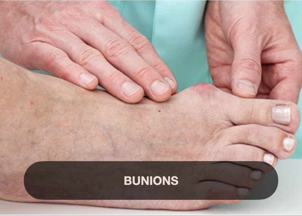 A person receiving a physical exam on their foot, focusing on the bunions on the big toe joint.