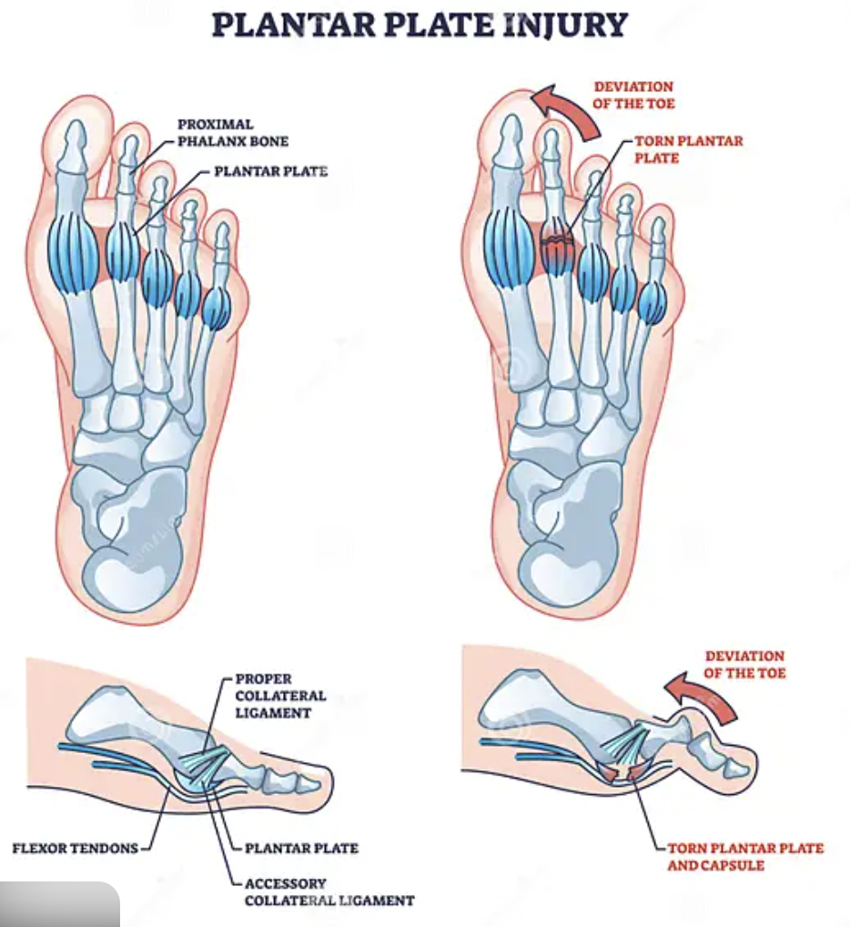 Diagram illustrating plantar plate injury, showing normal and injured toes. It depicts the anatomy of the foot, including the proximal phalanx, plantar plate, and other ligaments. The right side shows a torn plantar plate, deviation of the toe, and a torn capsule, while the lower section highlights the proper collateral ligament, accessory collateral ligament, and the effects of a torn plantar plate and capsule.