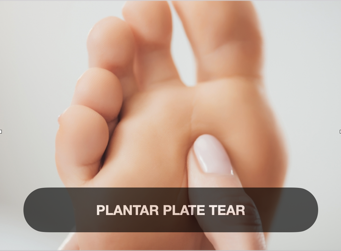 Close-up of a person pinching the heel of their foot, illustrating a plantar plate tear injury.