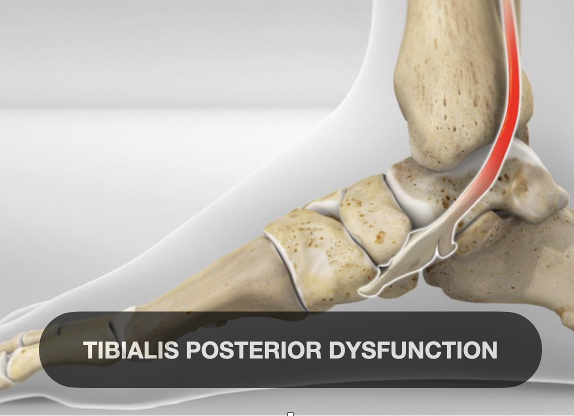 Illustration of a human ankle joint showing tibialis posterior muscle dysfunction affecting the posterior side of the tibia bone.