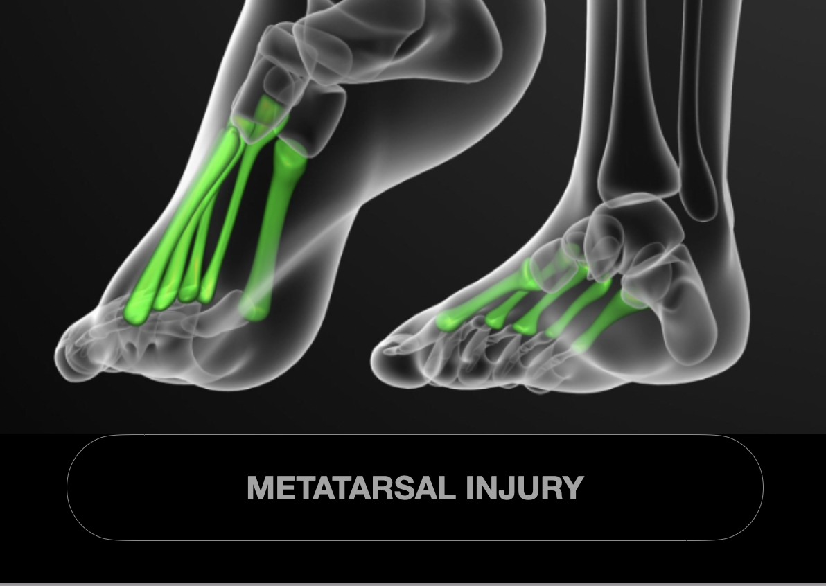 An x-ray illustration of both feet showing bones with green highlights indicating areas of metatarsal injury, with the label "Metatarsal Injury" at the bottom.