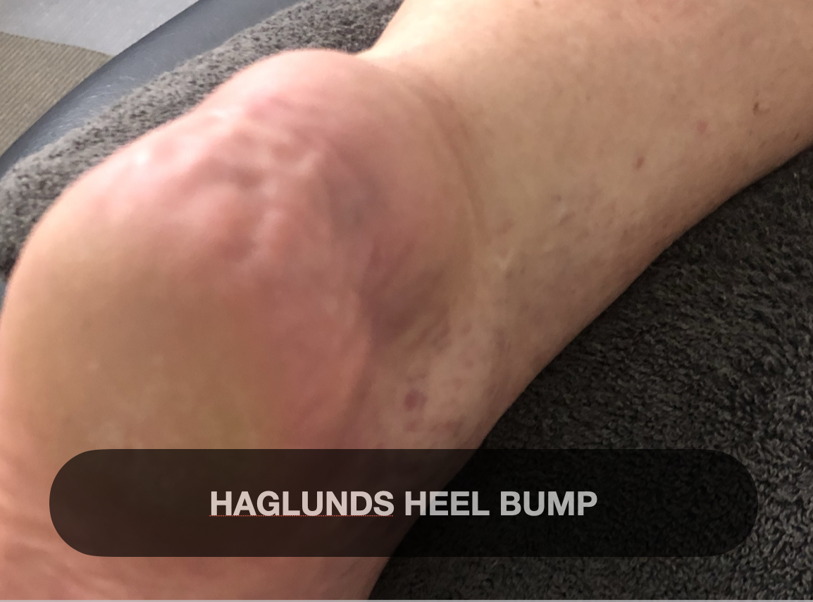 Close-up of a person's heel with a bump, labeled as Haglund's heel bump.