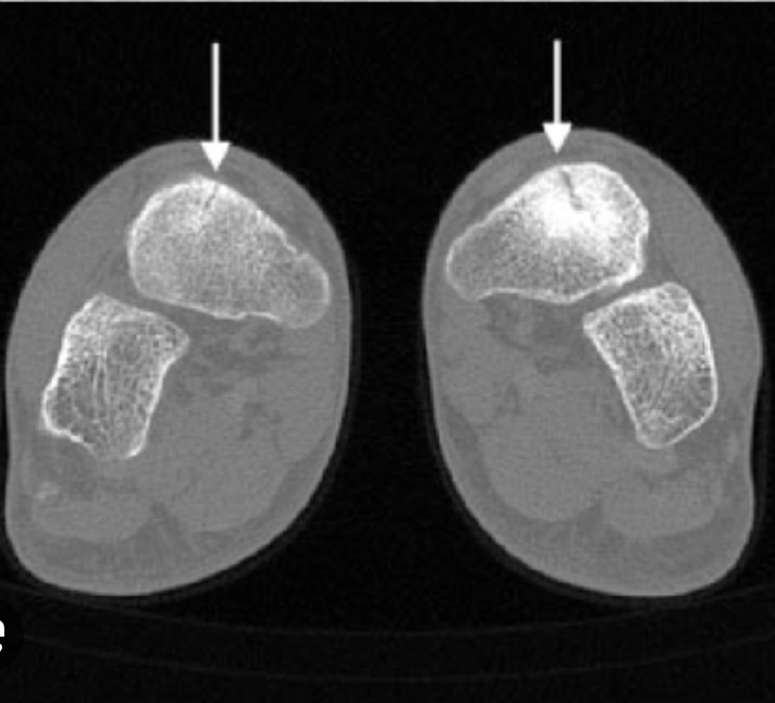 Black and white medical scan image showing two cross-sections of feet with highlighted areas indicating bones or tissues