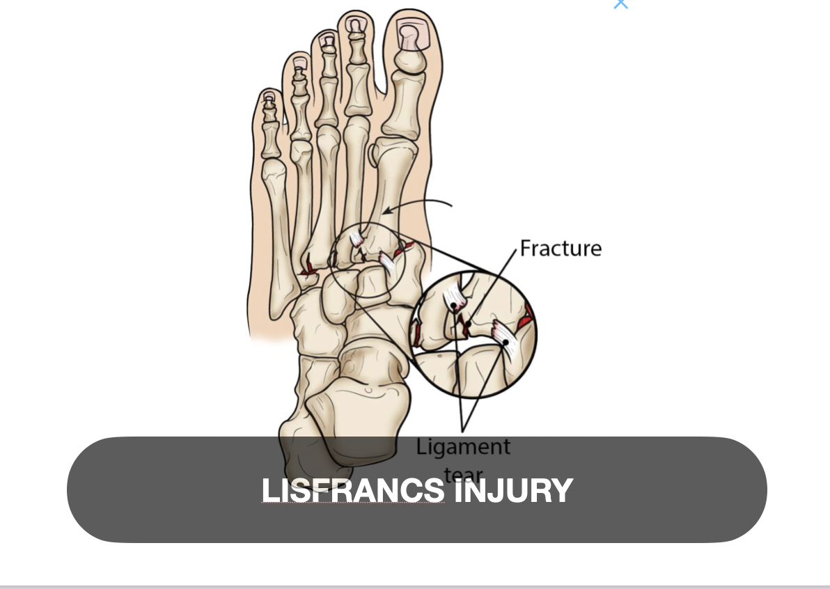 Diagram of a human hand showing a fractured bone in the finger with a close-up view of the fracture and ligament tear. The image is labeled 'LISFRANCS INJURY'.