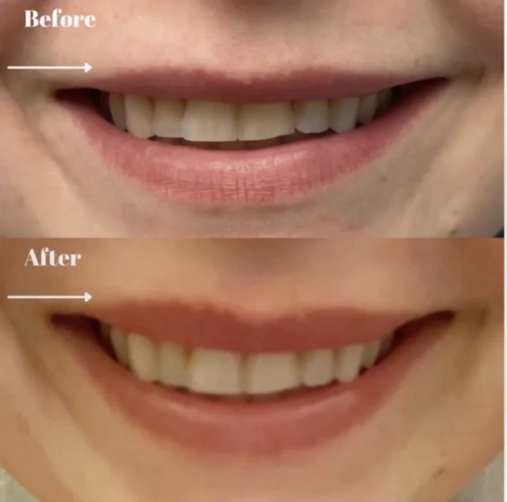 Is a Lip Flip Right for You?