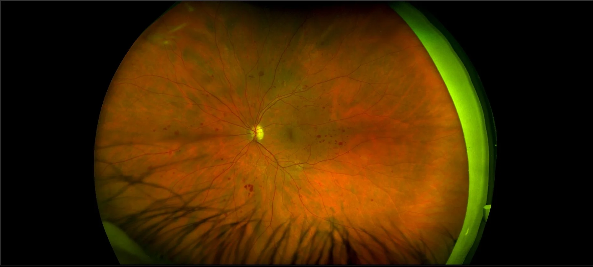 Optos - Diabetic Retinopathy