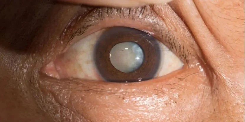 Cataracts - Things you Should Know