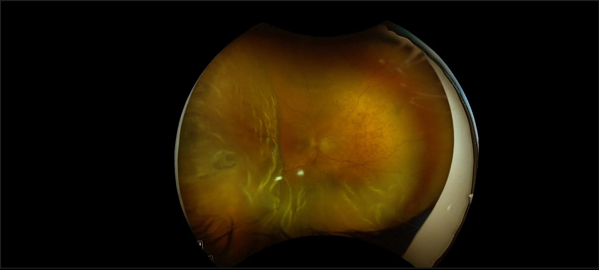 Eye Floaters, Flashes and Curtain-Like Vision: When to Seek Urgent Optometric Care