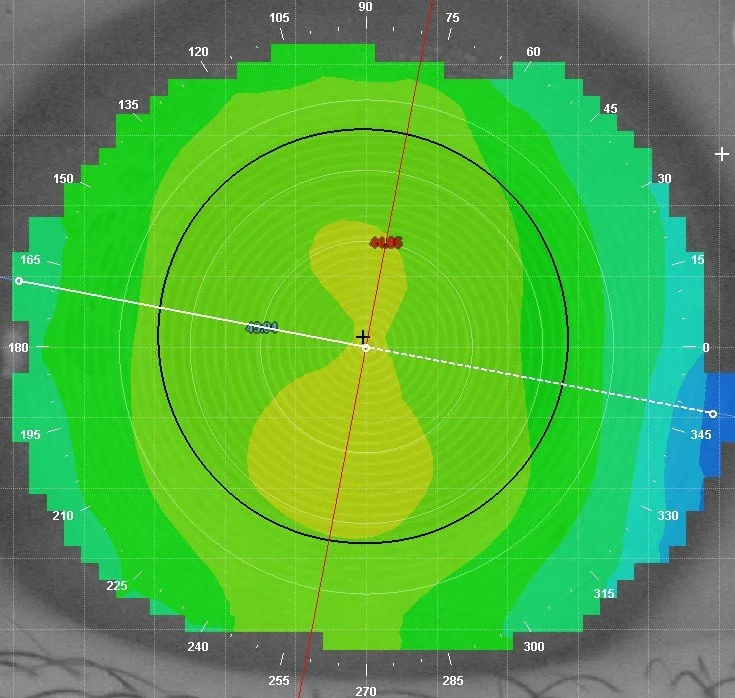 Medmont Topography - Mappping of eye for advance contact lens fitting