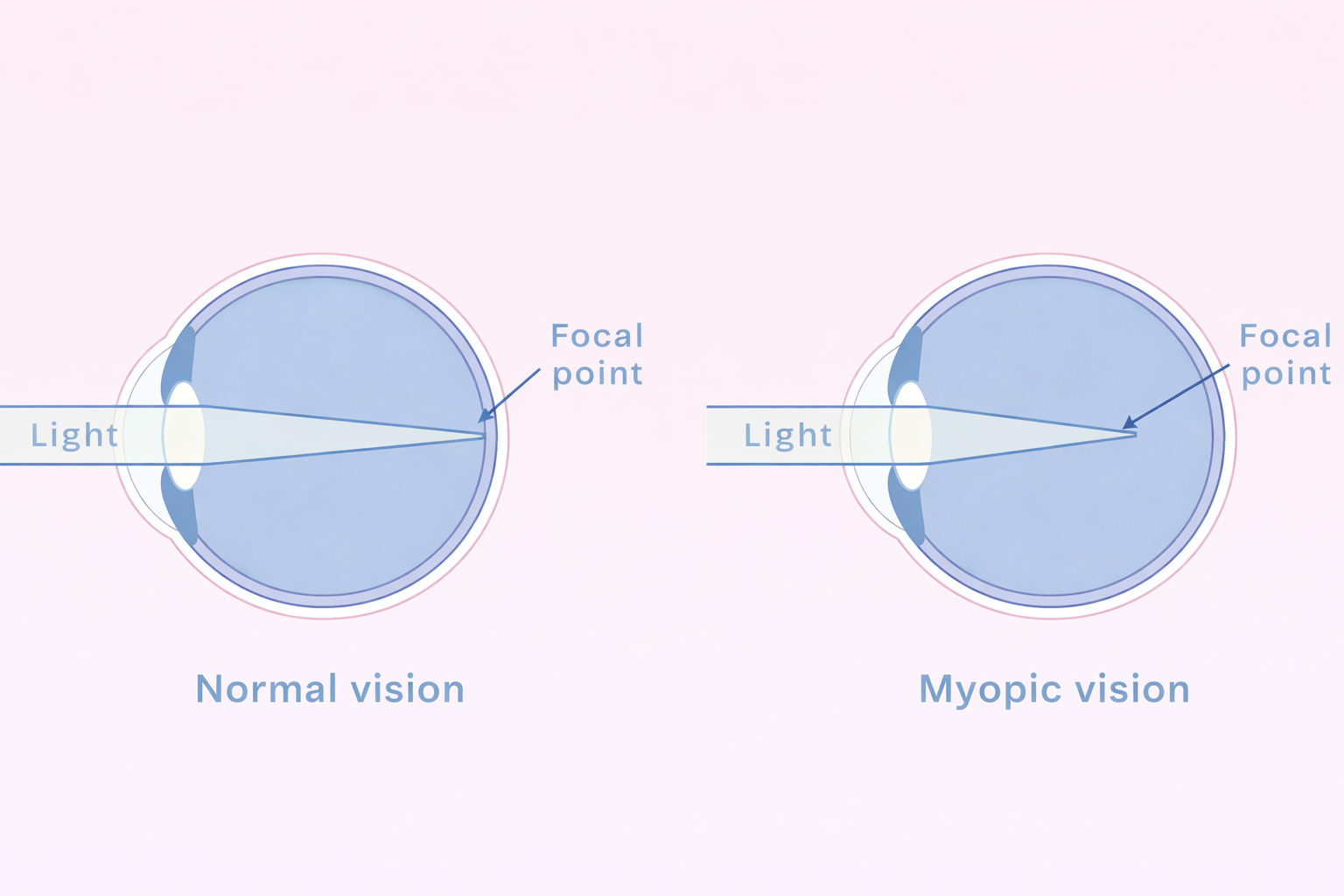 Myopia vs Normal