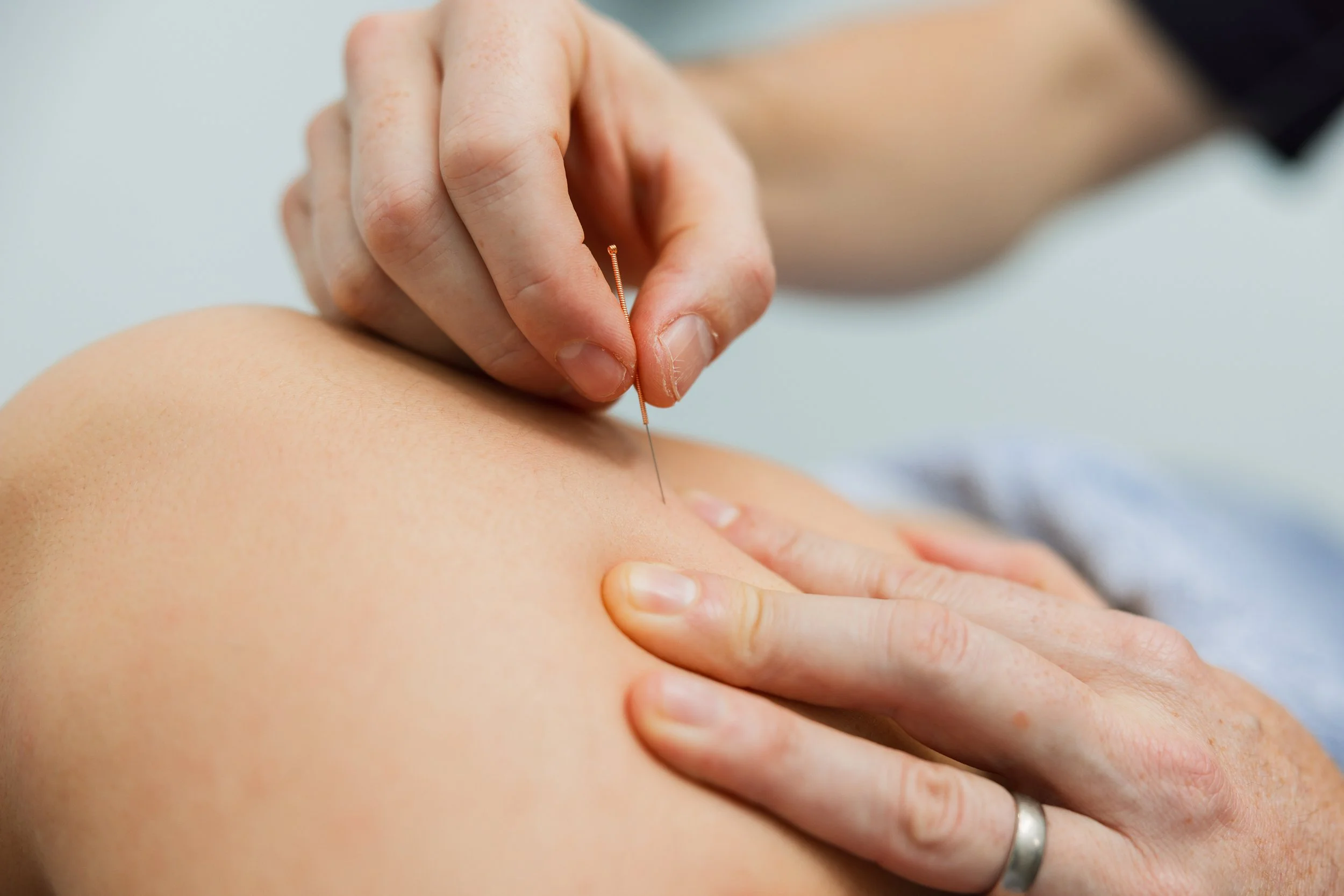 Person receiving acupuncture treatment on their shoulder, with a practitioner inserting a thin needle.