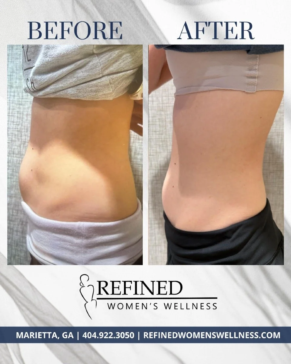 BEFORE AND AFTER ✨

Board-certified physician assistant specializing in aesthetics and wellness, Monica Keshwara, reports back on this incredible before and after: 

&quot;From April to July, after just six Ab Tone sessions, we saw a huge difference.